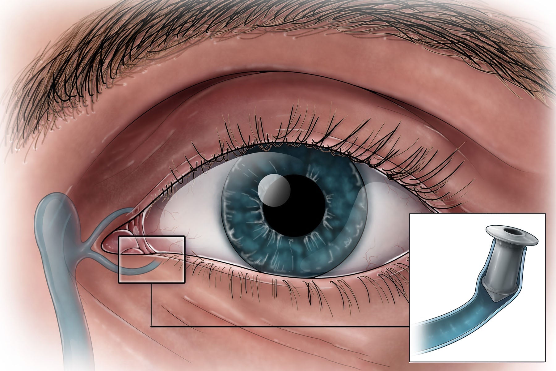Punctal Plugs – MedViaRX